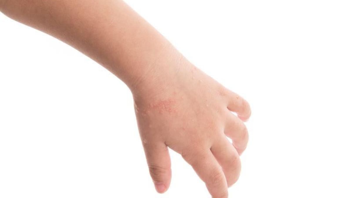 Psoriasis, Salud