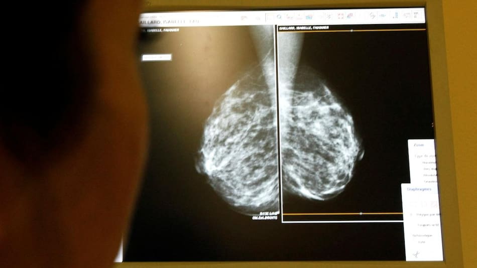 Exámenes de mamografía. Foto: Reuters