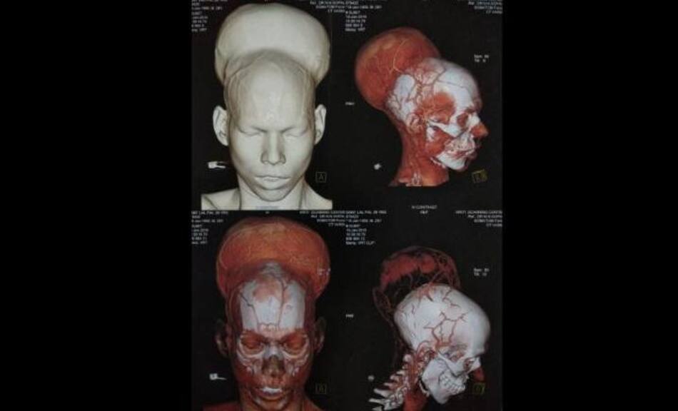 Tumor - India
