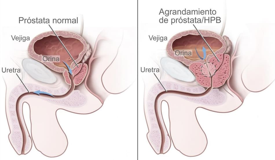 ubicación de la próstata