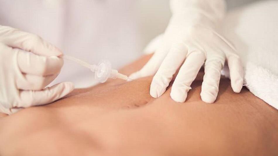 Carboxiterapia - salud