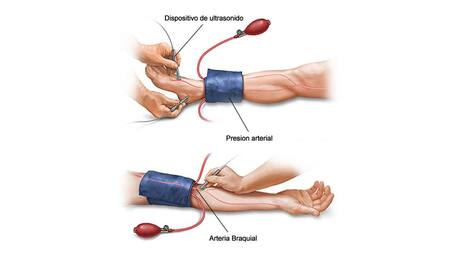 Enfermedad arterial periférica