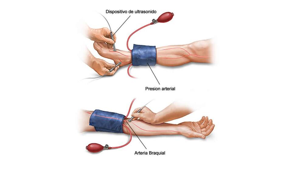 Enfermedad arterial periférica