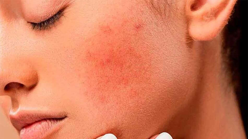 Dermatitis atópica