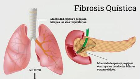 Fibrosis quística, OMS