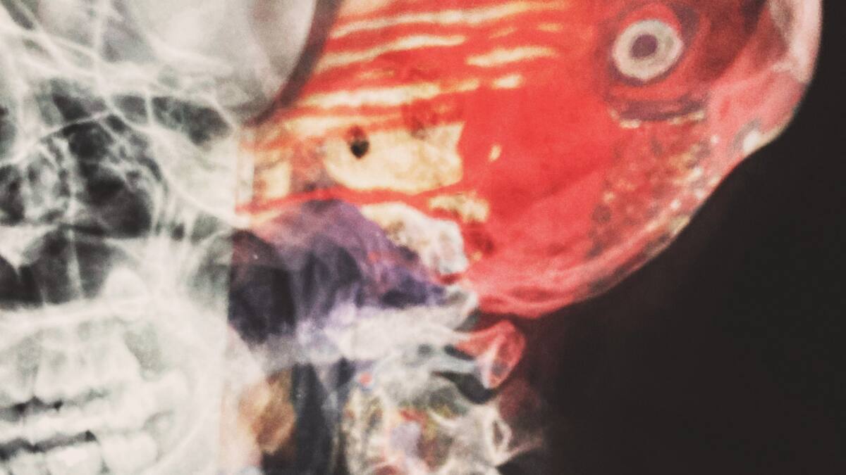 Implante cerebral, foto ilustrativa. Foto: Unsplash.
