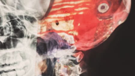 Implante cerebral, foto ilustrativa. Foto: Unsplash.