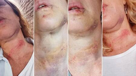 Una mujer muestra las heridas que le dejó un hombre en Belgrano R, foto NA