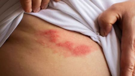 Culebrilla. Foto, Twitter: @CNNEE