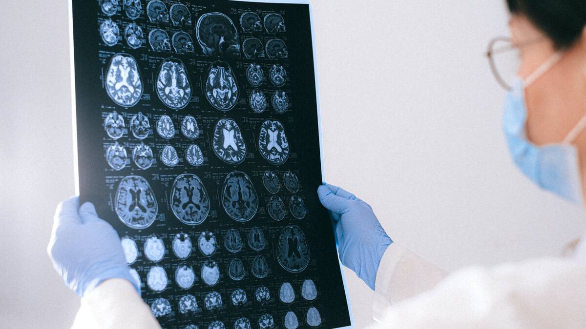 Células madre: un avance esperanzador para la esclerosis múltiple progresiva. Pexels