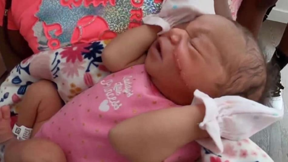 A una beba le cortaron la cara durante la cesárea