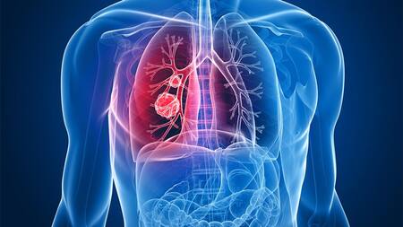 Cáncer de pulmón: presentaron en el país un nuevo tratamiento de alta eficacia