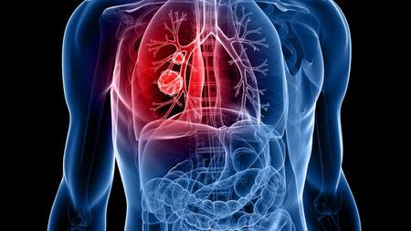 Salud - Cáncer pulmón