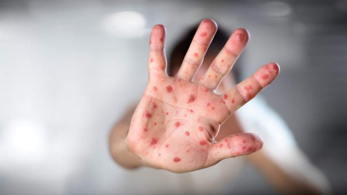Alerta sanitaria en CABA: registran el primer caso de la cepa más agresiva y contagiosa de la viruela del mono