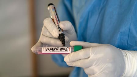 Mpox virus; viruela del mono. Foto: EFE.