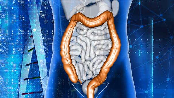 Un estudio relaciona las dietas ricas en calcio con un menor riesgo de cáncer de colon