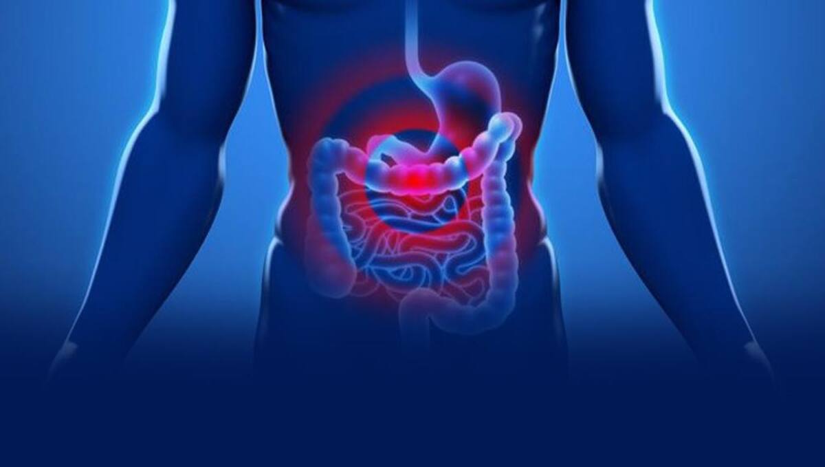 Cáncer de colon