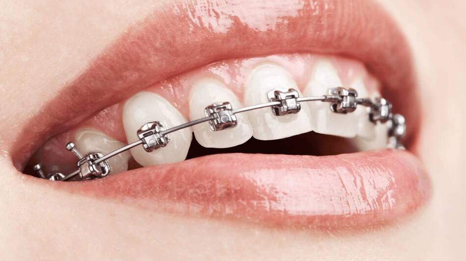 Brackets