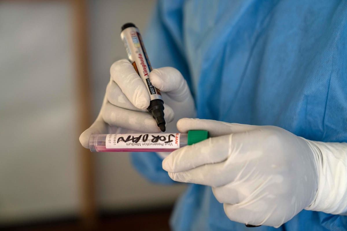 Mpox virus; viruela del mono. Foto: EFE.