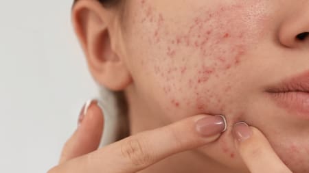 Acné, granos, piel. Foto: Unsplash