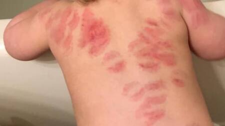 Niño mordido más de 25 veces en una guardería