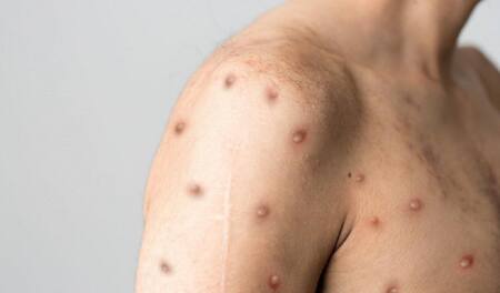 Viruela del mono, Foto NA