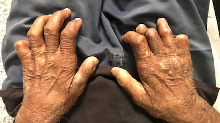 Chile se convirtió en el primer país de América en ser verificado como libre de lepra