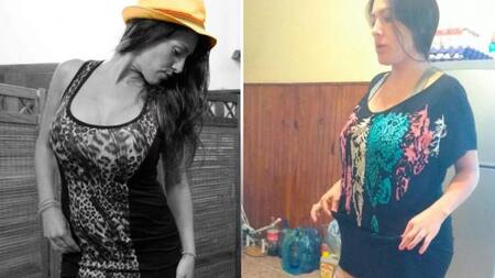 Mariela Ayala - Liposucción - Pierna amputada