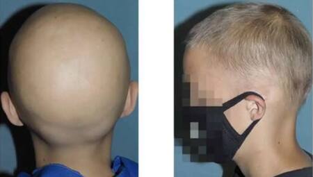 Aplicación del tratamiento en niño de 12 años. Foto: FDA