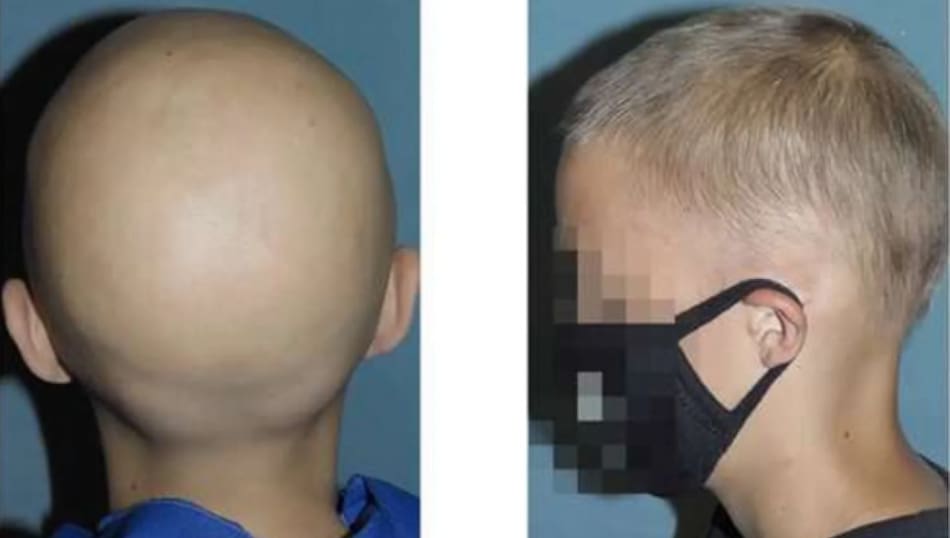 Aplicación del tratamiento en niño de 12 años. Foto:  FDA