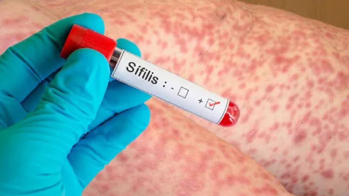 Alerta por el aumento de sífilis en Argentina: se registra el mayor número de casos desde que se tienen registros oficiales