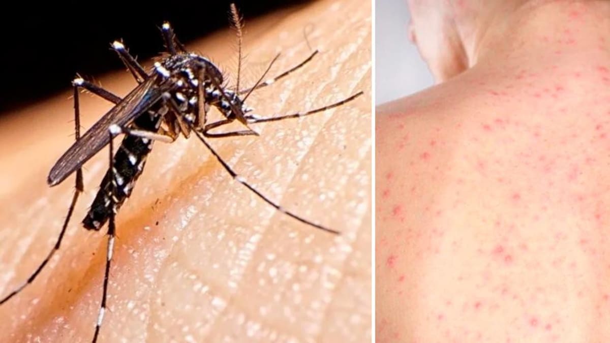 Dengue y sarampión, enfermedades, salud