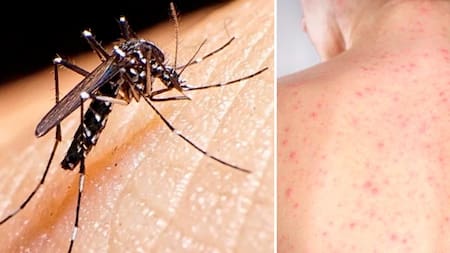 Dengue y sarampión, enfermedades, salud