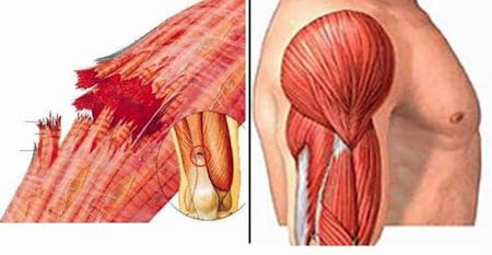 Rabdomiólisis - Salud