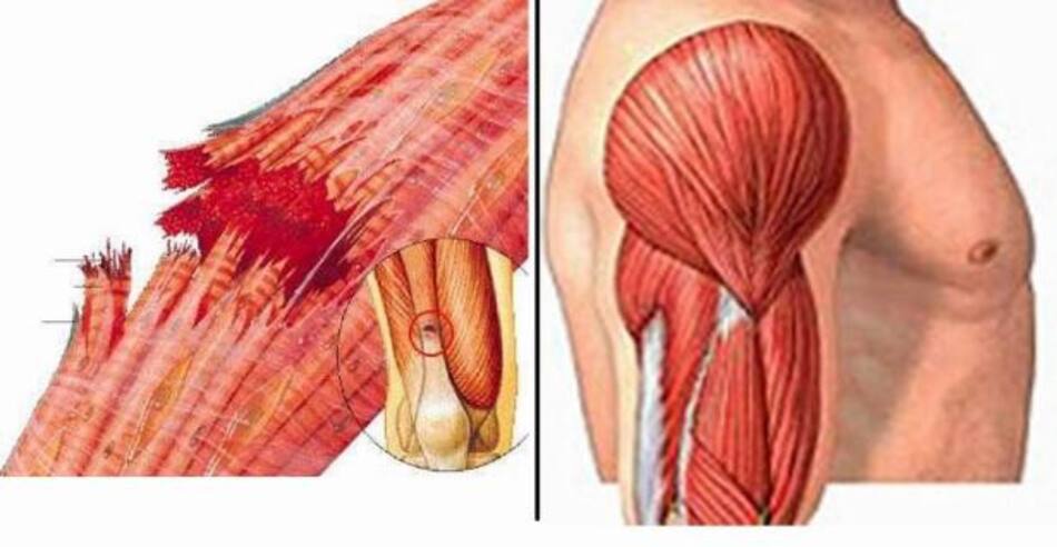 Rabdomiólisis - Salud