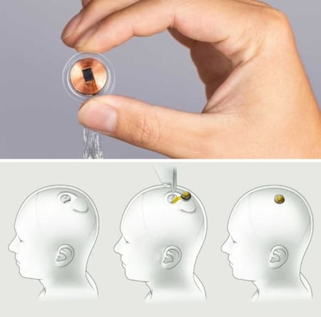 el primer implante de un chip cerebral en un ser humano, Telepathy. Foto: X