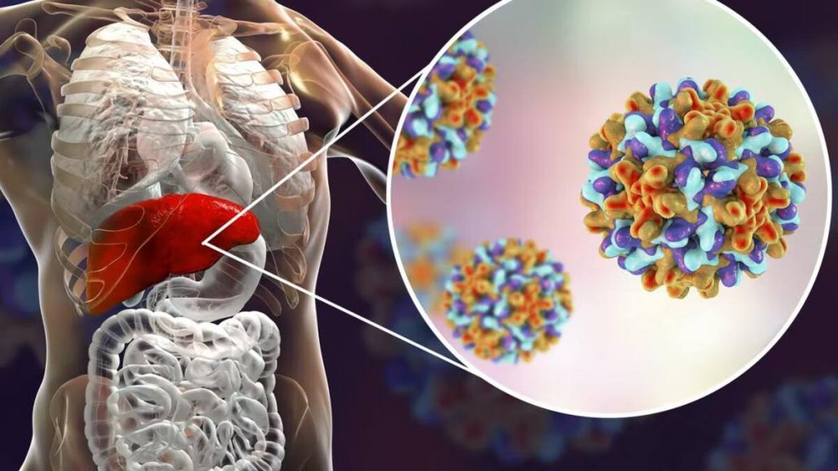 Hepatitis