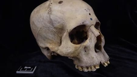 Descubren un graneo con rastros de una operación contra el cáncer realizada hace 4 mil años. Foto: X