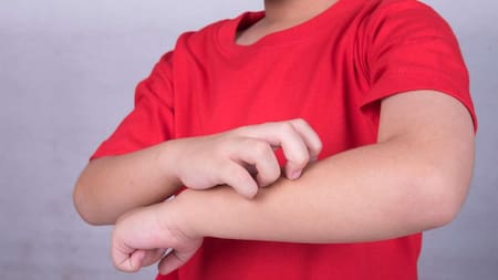 Dermatitis atópica, enfermedad de la piel, salud