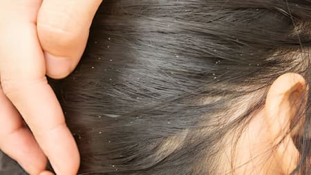Cabello con caspa. Foto: Unsplash.