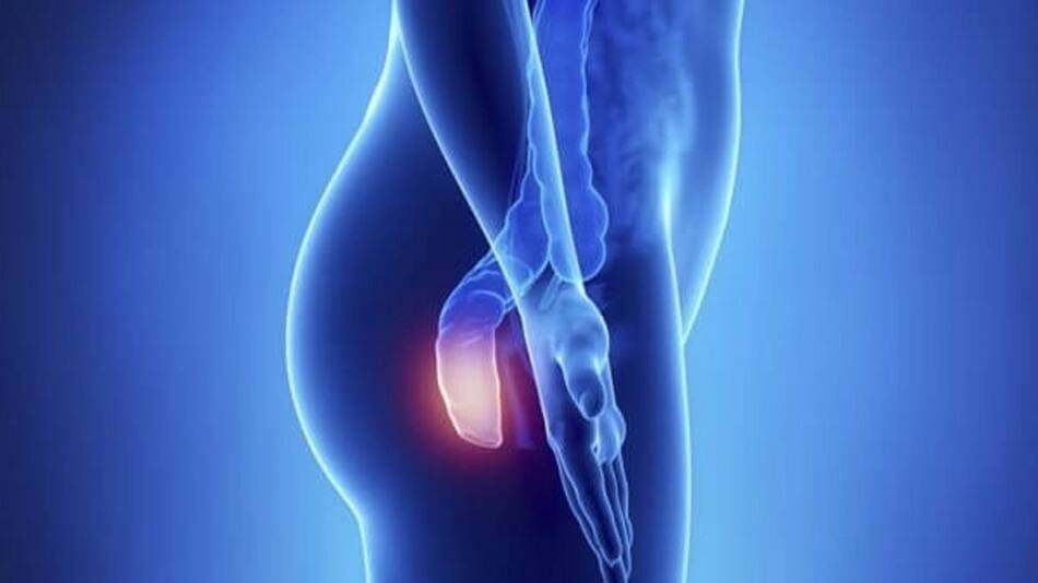 Cáncer de ano - Salud - Enfermedad