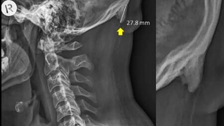 El uso del celular modificó el esqueleto humano
