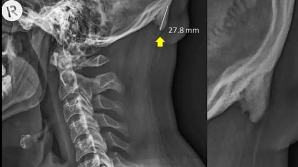 El uso del celular modificó el esqueleto humano