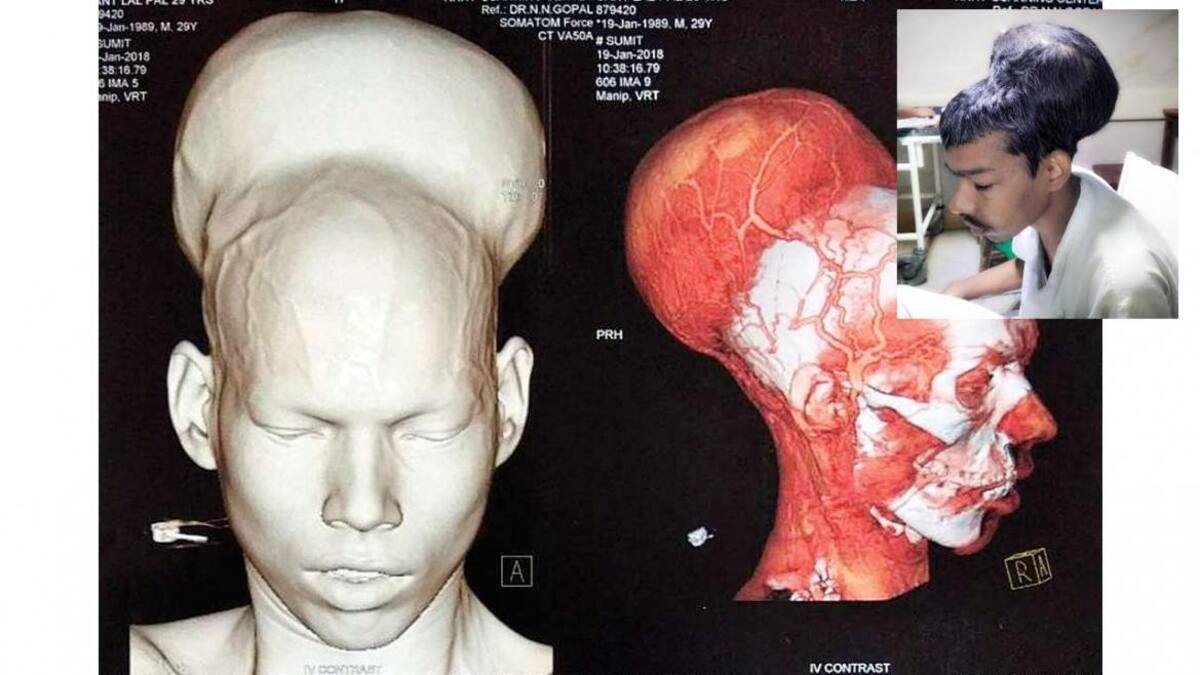 Tumor - India