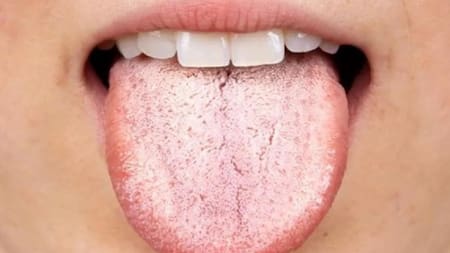 Brote de sífilis en Argentina: ¿por qué tener la lengua blanca puede ser un síntoma?