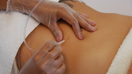 Carboxiterapia - salud