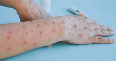 Viruela del mono. Foto: NA.