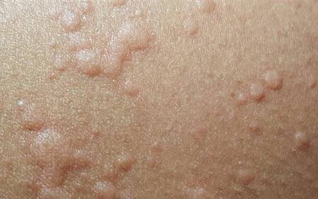 Coronavirus, piel, salud