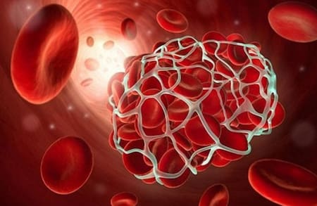 13 de octubre, Día Mundial de la Trombosis