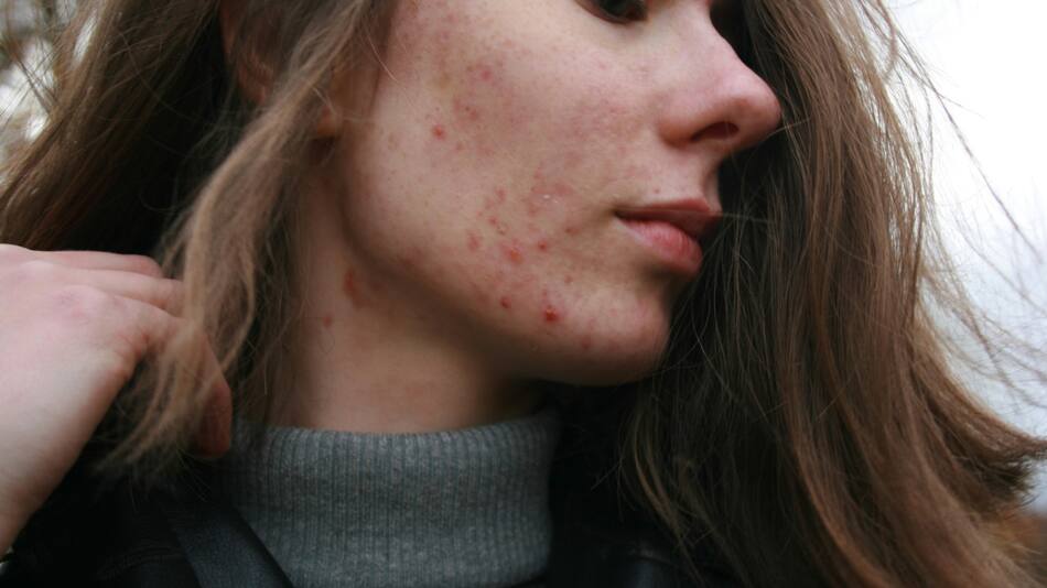 Acné, granos, piel. Foto: Unsplash